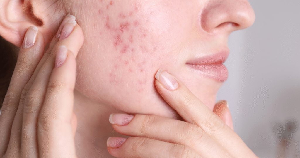 diferentes tipos de acne e seus tratamentos