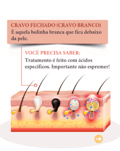 diferentes tipos de acne e seus tratamentos