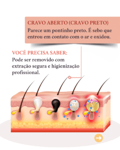 diferentes tipos de acne e seus tratamentos