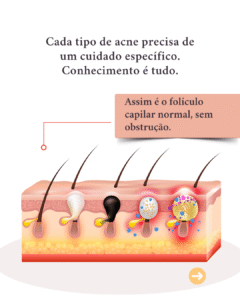 diferentes tipos de acne e seus tratamentos