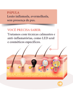 diferentes tipos de acne e seus tratamentos