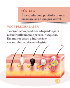 diferentes tipos de acne e seus tratamentos