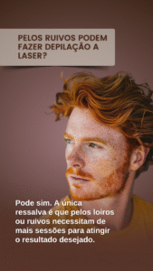 depilação a laser masculina