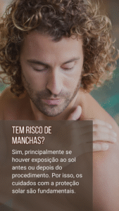 depilação a laser masculina